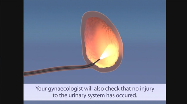 Subtotal Laparoscopic Hysterectomy