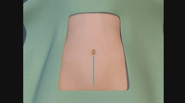 Total Laparoscopic Hysterectomy - Bilateral